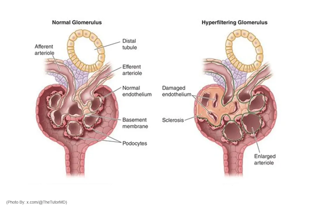 Hiperfiltrasi Glomerulus